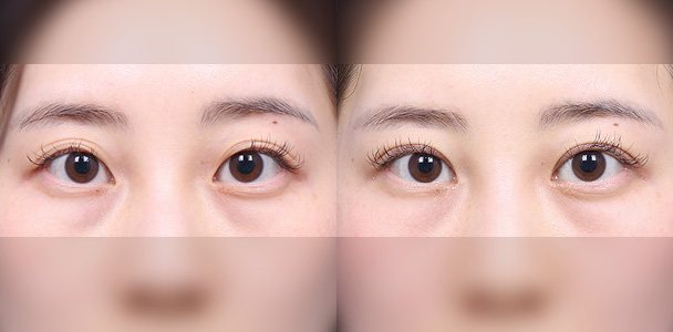 눈성형 수술 전·후 비교 사진(눈 정면 — 왼쪽 수술 전 / 오른쪽 수술 후 1개월, 이마·입 부위 흐림 처리)