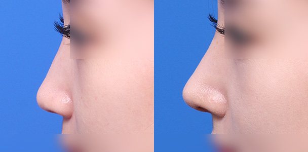 코성형 수술 전·후 비교 사진(코 측면 — 왼쪽 수술 전 / 오른쪽 수술 후 1개월, 이마·입 부위 흐림 처리)