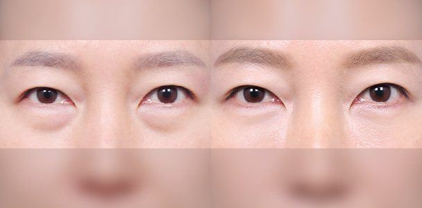 눈밑지방재배치 수술 전·후 비교 사진(눈·눈밑 정면 — 왼쪽 수술 전 / 오른쪽 수술 후 1개월, 이마·입 부위 흐림 처리)