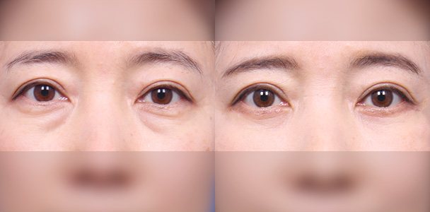 하안검 수술 전·후 비교 사진(눈·눈밑 정면 — 왼쪽 수술 전 / 오른쪽 수술 후 1개월, 이마·입 부위 흐림 처리)