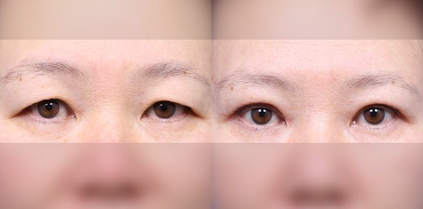 상안검 수술 전·후 비교 사진(눈 정면 — 왼쪽 수술 전 / 오른쪽 수술 후 1개월, 이마·입 부위 흐림 처리)