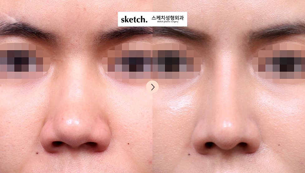매부리코성형 수술 전·후 사진 정면(왼쪽 수술 전 / 오른쪽 수술 후 1개월, 눈 부위 모자이크, 가운데 위 'sketch. 스케치성형외과' 워터마크)