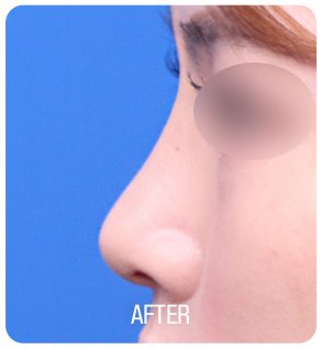 낮은코 성형 수술 후 사진(측면, 눈 부위 흐림 처리, 아래 'AFTER' 글자 박힘)