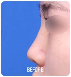 낮은코 성형 수술 전 사진(측면, 눈 부위 흐림 처리, 아래 'BEFORE' 글자 박힘)