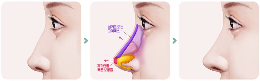 낮은코 수술방법 그림 3단계(수술 전 옆모습 → 콧대에 보형물·코끝에 연골을 넣는 그림 → 수술 후 옆모습)