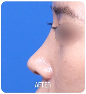 짧은코 성형 수술 후 사진(측면, 눈 부위 흐림 처리, 아래 'AFTER' 글자 박힘)