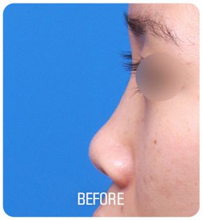 짧은코 성형 수술 전 사진(측면, 눈 부위 흐림 처리, 아래 'BEFORE' 글자 박힘)