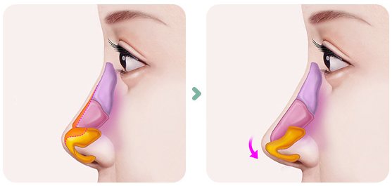 연골성형술 그림 2단계(콧날개 연골 위쪽 절제선 → 코끝이 내려간 모습)