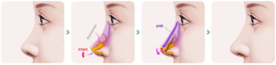 연골성형술+연골이식술+융비술 그림 4단계(수술 전 → 자가조직·연골 이식 → 콧등 실리콘 삽입 → 수술 후)