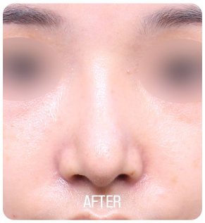 복코 성형 수술 후 사진(정면, 눈 부위 흐림 처리, 아래 'AFTER' 글자 박힘)