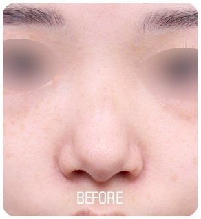 복코 성형 수술 전 사진(정면, 눈 부위 흐림 처리, 아래 'BEFORE' 글자 박힘)