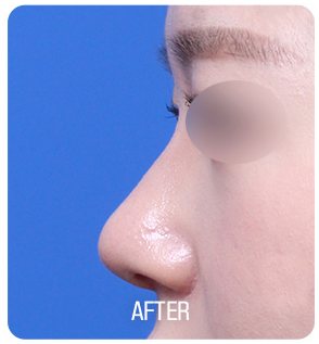 매부리코 성형 수술 후 사진(측면, 눈 부위 흐림 처리, 아래 'AFTER' 글자 박힘)