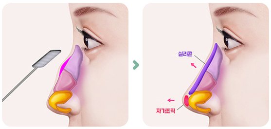 매부리 절골 및 콧대 높히기 그림 2단계(매부리 절골 → 실리콘·자가조직 보충)