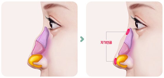 자가연골 삽입 그림 2단계(매부리 위·아래 들어간 부분 → 자가연골 삽입)