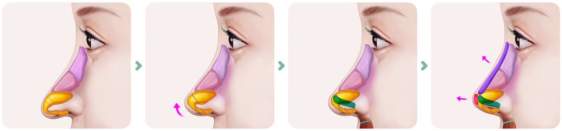 화살코/긴코 수술방법 그림 4단계(처진 코끝 옆모습 → 콧날개 연골 재배치 → 귀 연골 이식 → 코끝이 올라간 모습)