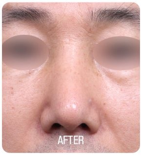 휜코 성형 수술 후 사진(정면, 눈 부위 흐림 처리, 아래 'AFTER' 글자 박힘)