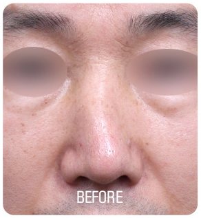 휜코 성형 수술 전 사진(정면, 눈 부위 흐림 처리, 아래 'BEFORE' 글자 박힘)