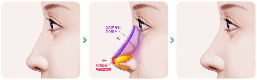 보형물 삽입 그림 3단계(수술 전 옆모습 → 콧대 보형물·코끝 연골 삽입 → 수술 후)