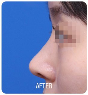 무보형물 코성형 수술 후 사진(측면, 눈 부위 흐림 처리, 아래 'AFTER' 글자 박힘)