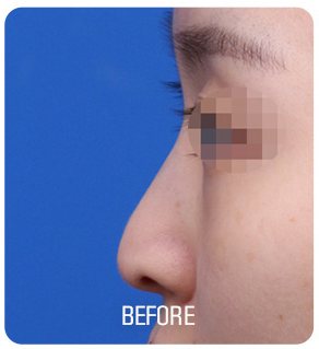 무보형물 코성형 수술 전 사진(측면, 눈 부위 흐림 처리, 아래 'BEFORE' 글자 박힘)