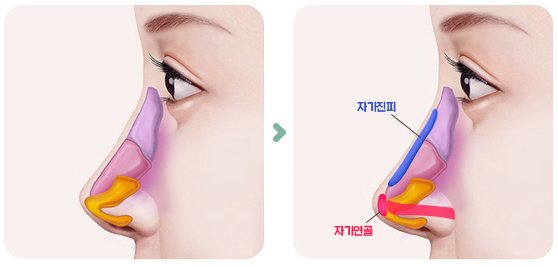 연골과 자가진피로 수술한 경우 그림 2단계(수술 전 → 콧대 자가진피·코끝 자가연골)