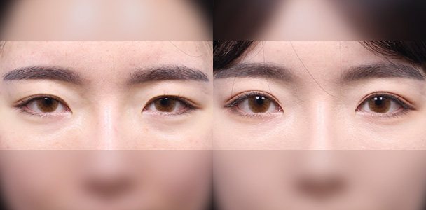 눈성형 수술 전·후 비교 사진(눈 정면 — 왼쪽 수술 전 / 오른쪽 수술 후 1개월, 이마·입 부위 흐림 처리)