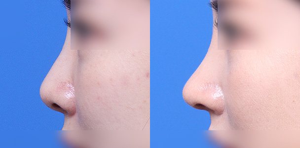 코성형 수술 전·후 비교 사진(코 측면 — 왼쪽 수술 전 / 오른쪽 수술 후 1개월, 이마·입 부위 흐림 처리)