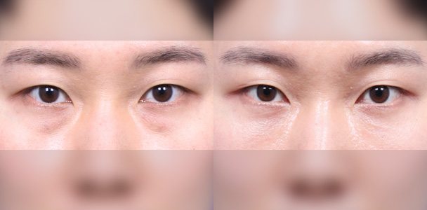 눈밑지방재배치 수술 전·후 비교 사진(눈·눈밑 정면 — 왼쪽 수술 전 / 오른쪽 수술 후 1개월, 이마·입 부위 흐림 처리)