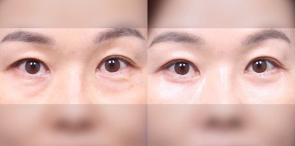 하안검 수술 전·후 비교 사진(눈·눈밑 정면 — 왼쪽 수술 전 / 오른쪽 수술 후 1개월, 이마·입 부위 흐림 처리)