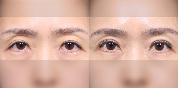 상안검 수술 전·후 비교 사진(눈 정면 — 왼쪽 수술 전 / 오른쪽 수술 후 1개월, 이마·입 부위 흐림 처리)